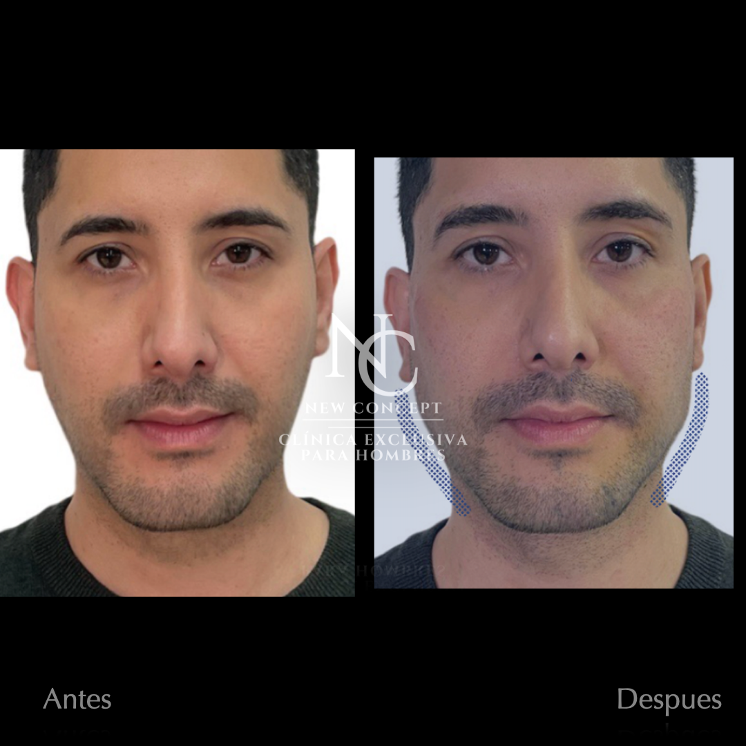 Antes y después — Masculinización Facial