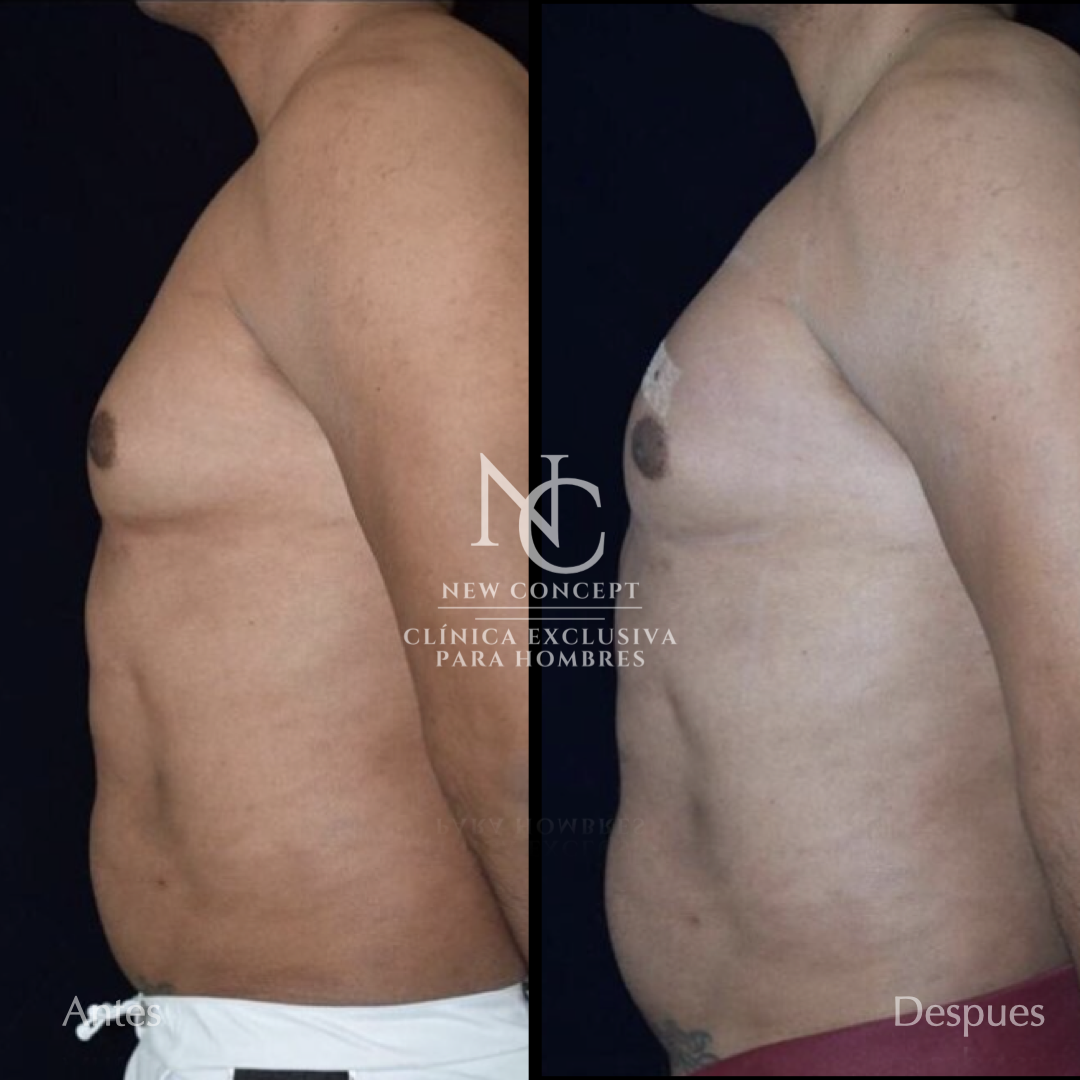 Antes y después — Aumento de Pectorales